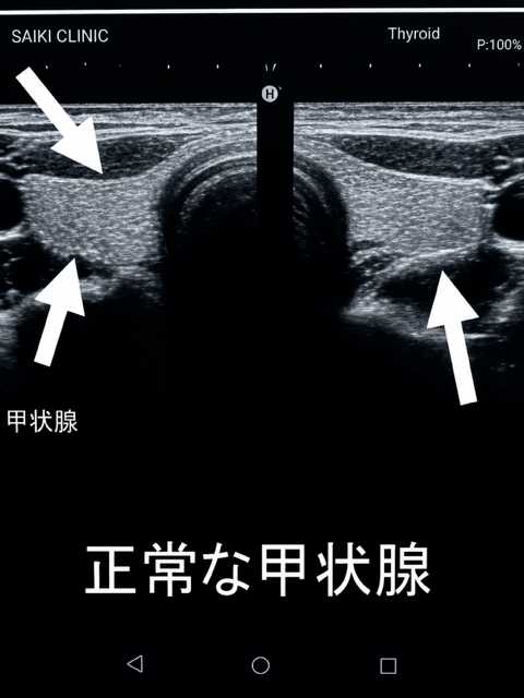 甲状腺エコー