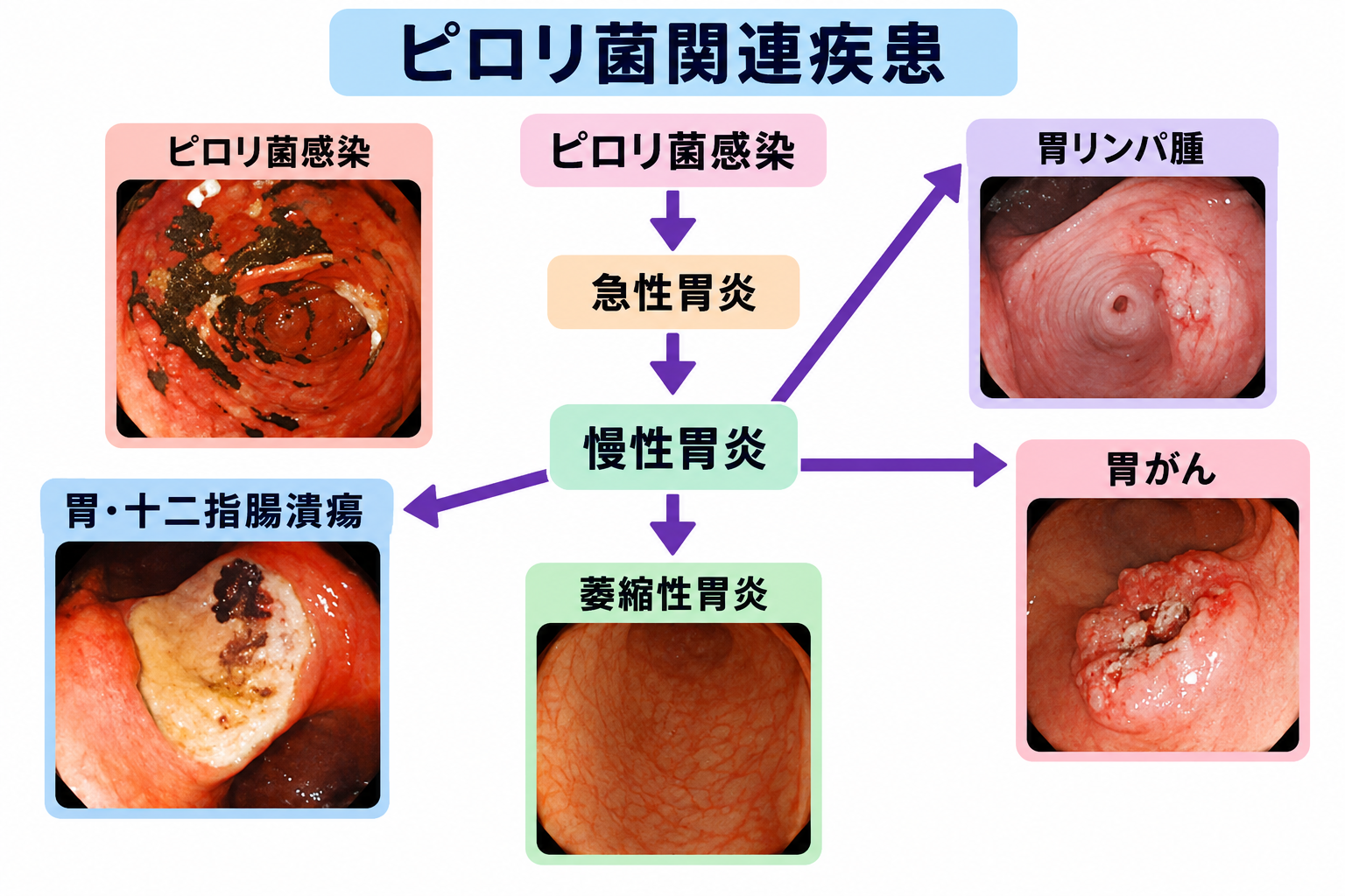 ピロリ菌関連疾患
