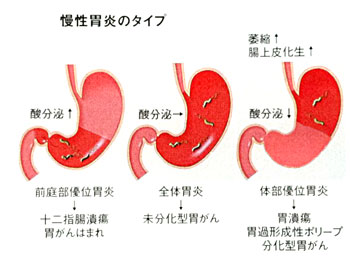 慢性胃炎のタイプ
