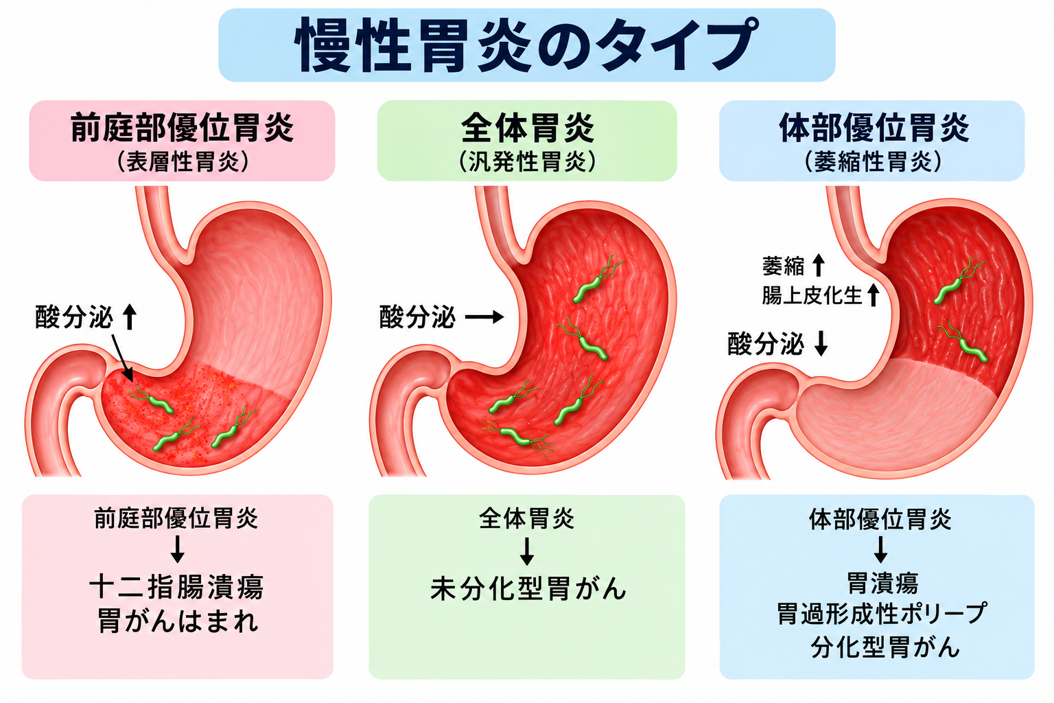 慢性胃炎のタイプ